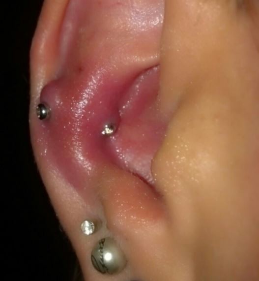 Esempio di lieve infezione da piercing all'orecchio