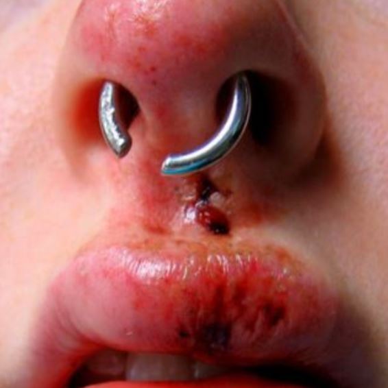 Esempio di infezione da piercing estesa a naso e bocca