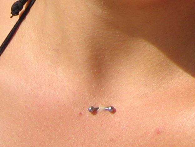 Esempio di rigetto di un piercing surface sul collo